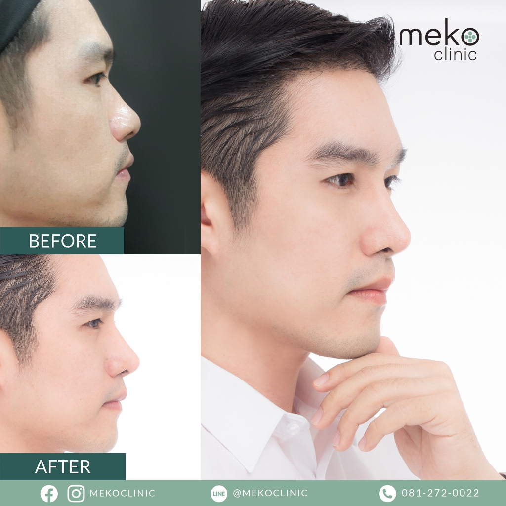 เสริมจมูกผู้ชาย ต้องเสริมแบบไหนที่นี่มีคำตอบ- Meko Clinic เสริมจมูกผู้ชาย ต้องเสริมแบบไหนที่นี่มีคำตอบ- Meko Clinic