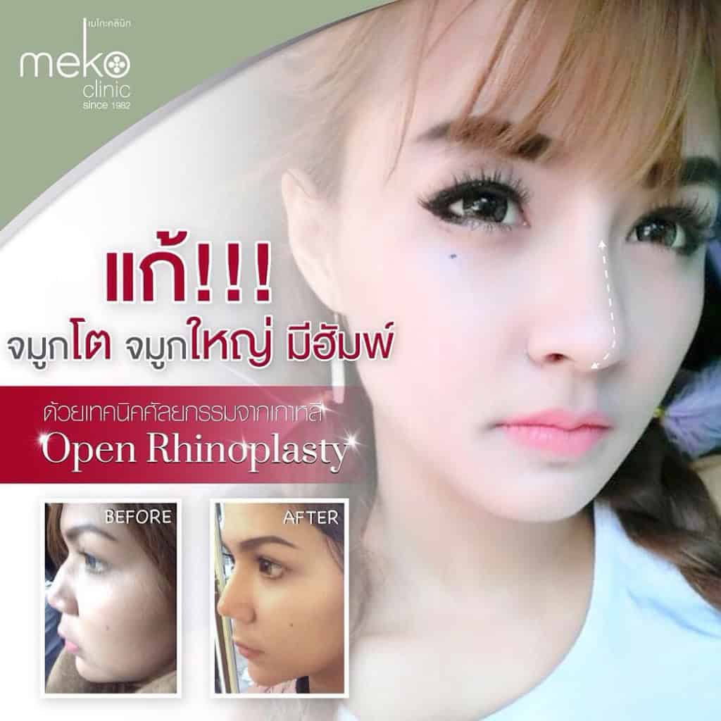 เสริมจมูกแบบ Open เมโกะ คลินิก
