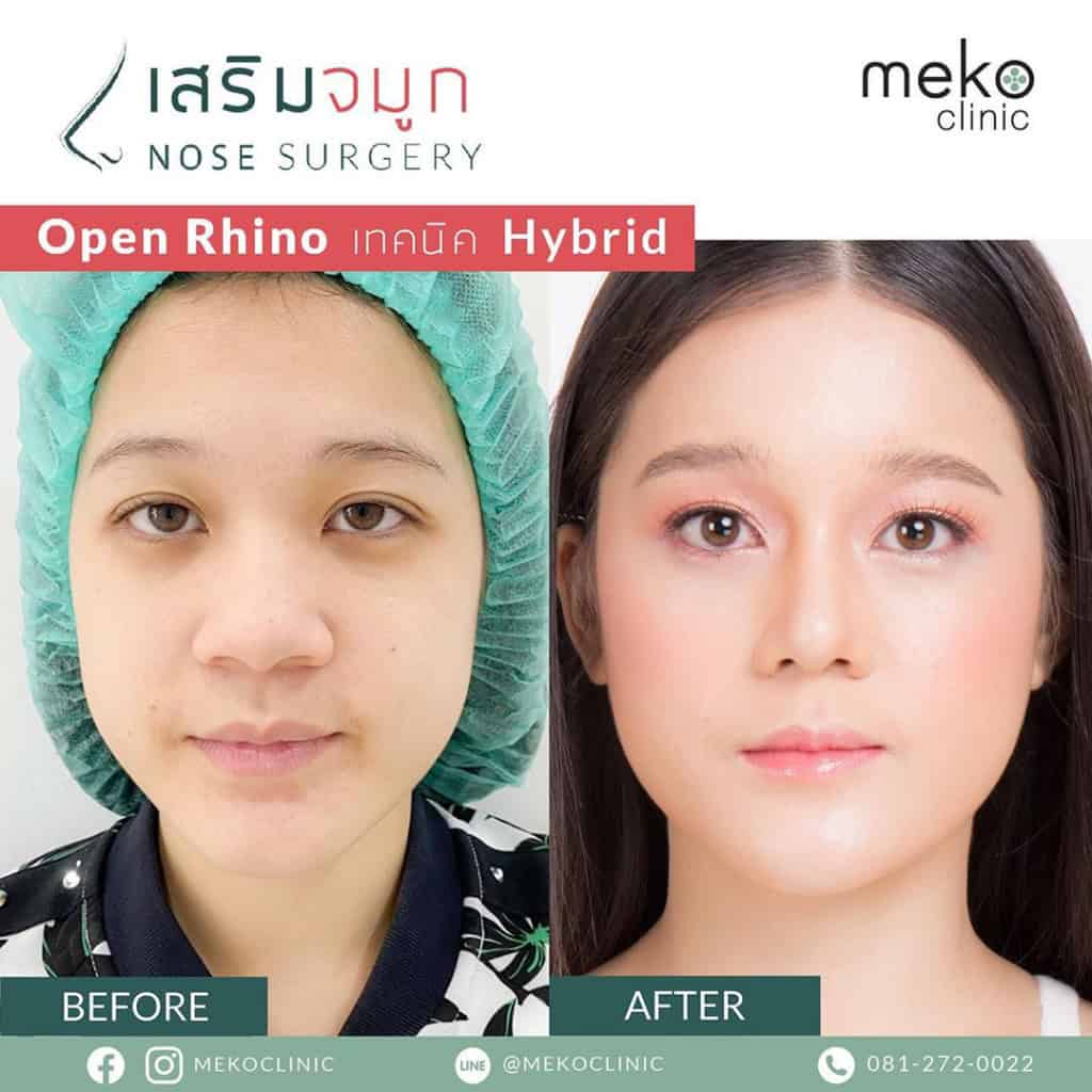 เสริมจมูกแบบ Open เมโกะ คลินิก