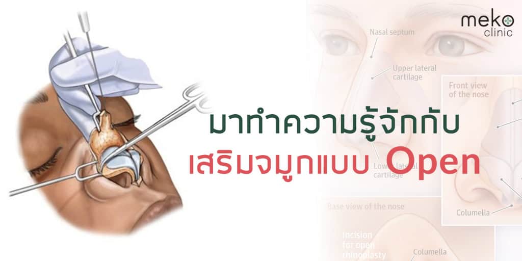 เสริมจมูกแบบ Open เมโกะ คลินิก