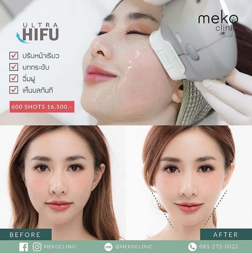 Hifu ยกกระชับหน้า ลดริ้วรอย ปรับรูปหน้า เมโกะ คลินิก