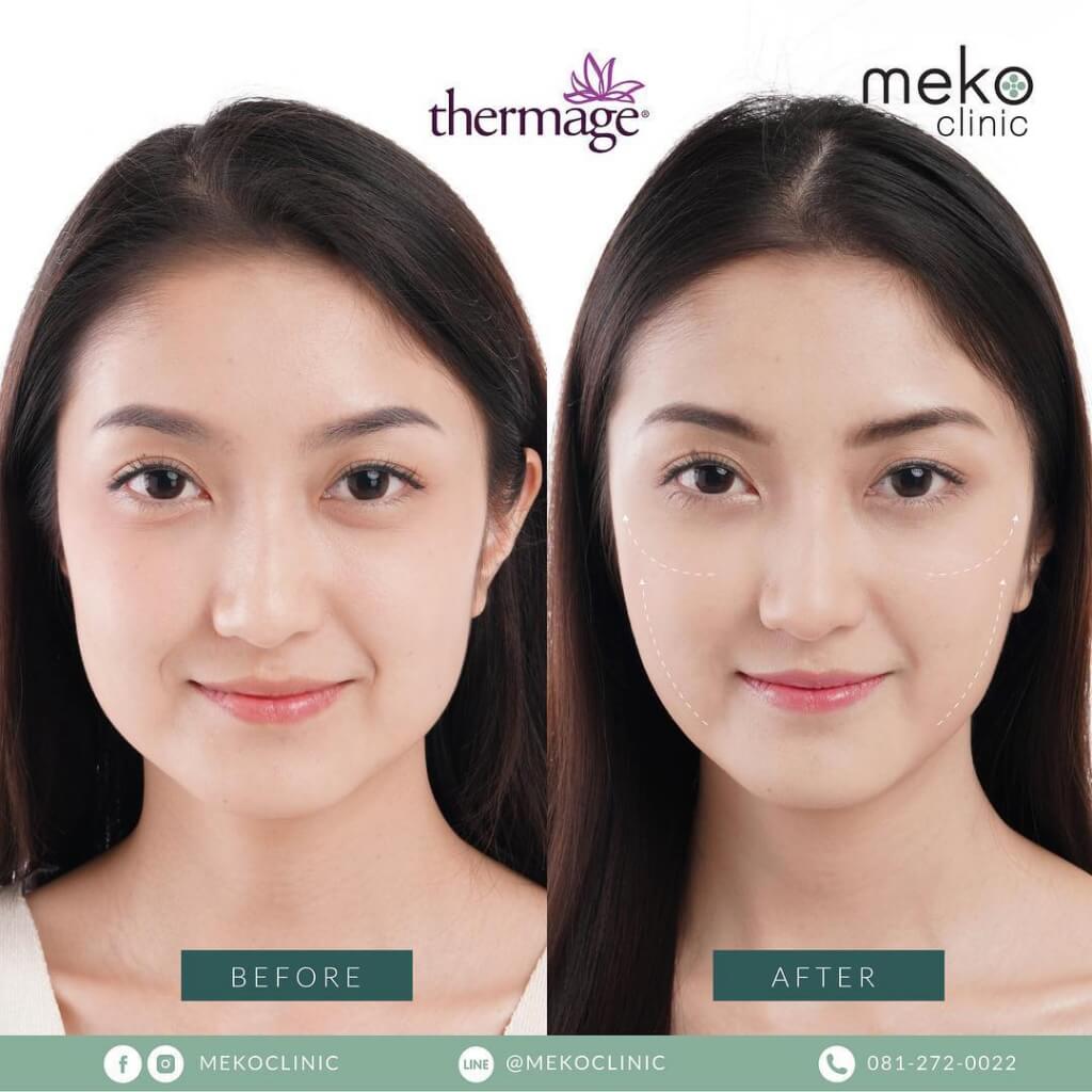 Thermage เทอมาจ ยกกระชับหน้า ลดริ้วรอย ปรับรูปหน้า เมโกะคลินิก