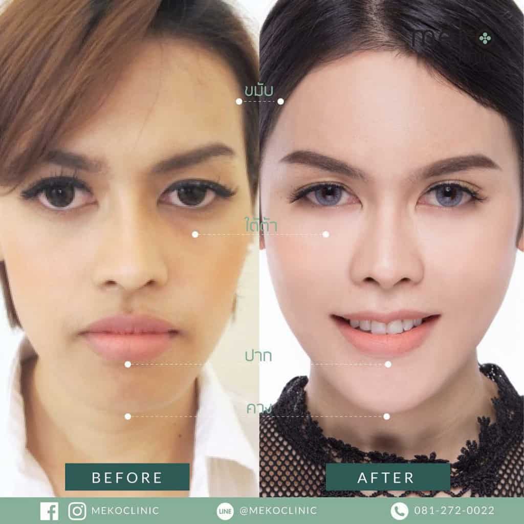 ฟิลเลอร์ Filler ปรับรูปหน้า เมโกะ คลินิก