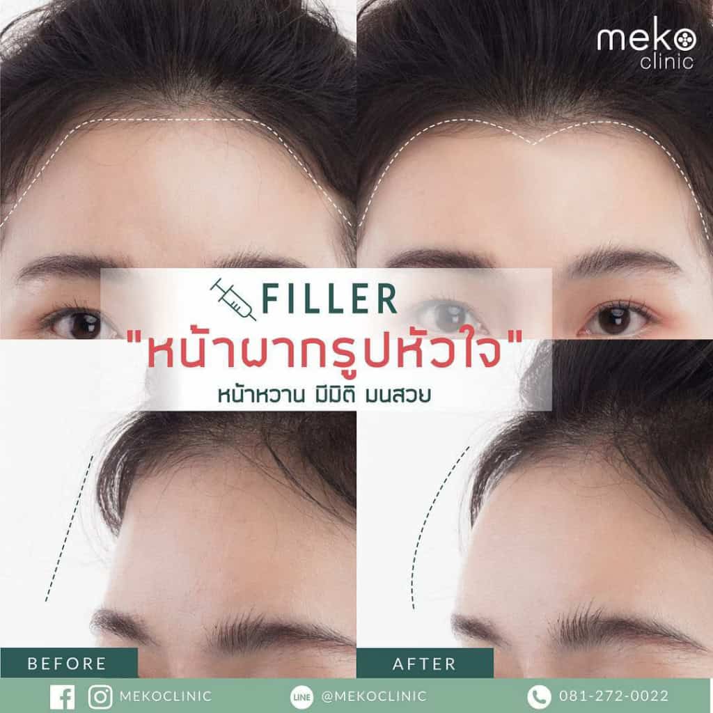 ฟิลเลอร์ Filler ปรับรูปหน้า เมโกะ คลินิก