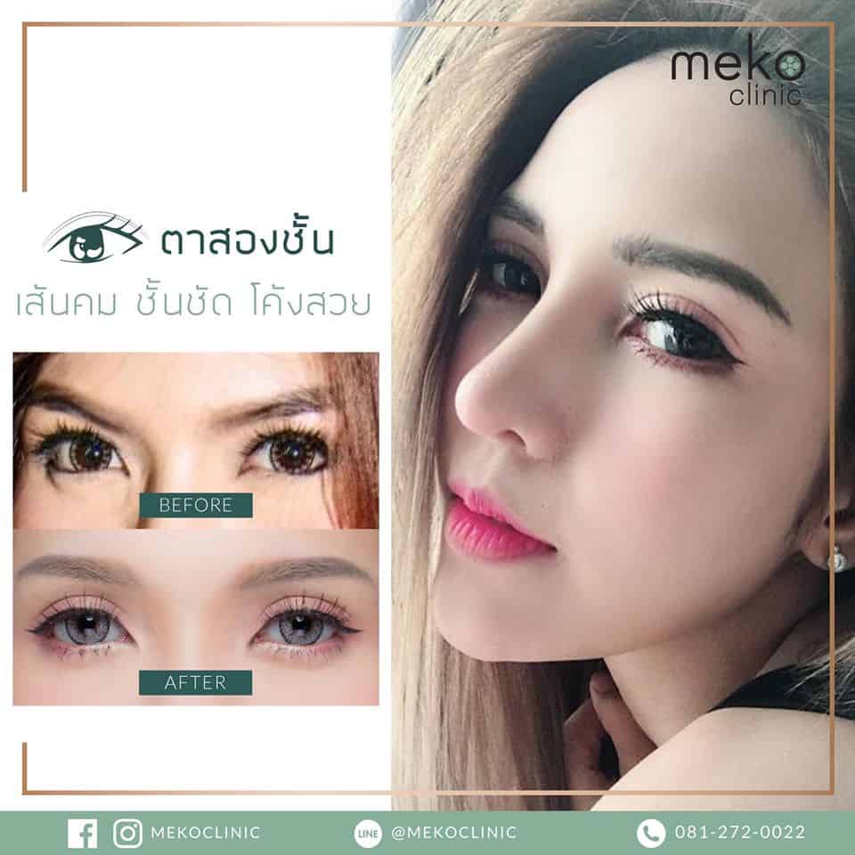 Eyes Surgery ตาสองชั้น เมโกะ คลินิก