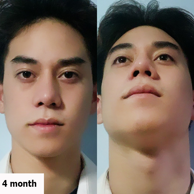 เสริมจมูก open หมอยศ เมโกะ คลินิก คุณโฟว์