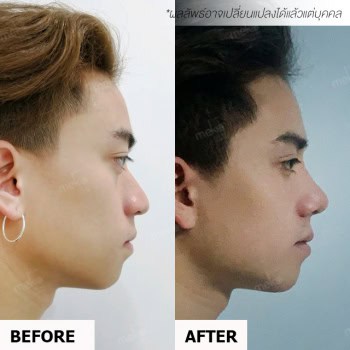 เสริมจมูก open หมอยศ เมโกะ คลินิก คุณโฟว์