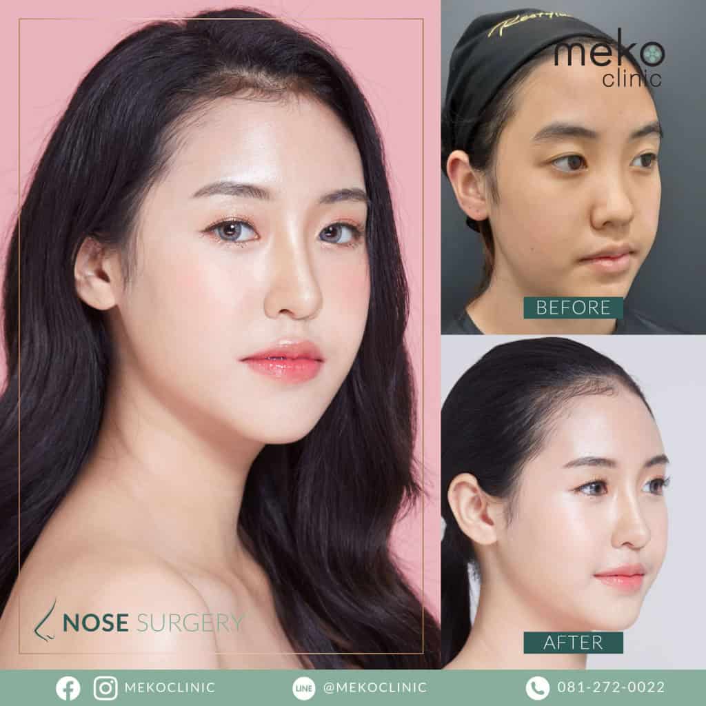 เสริมจมูก ( Nose surgery ) ที่ เมโกะ คลินิก