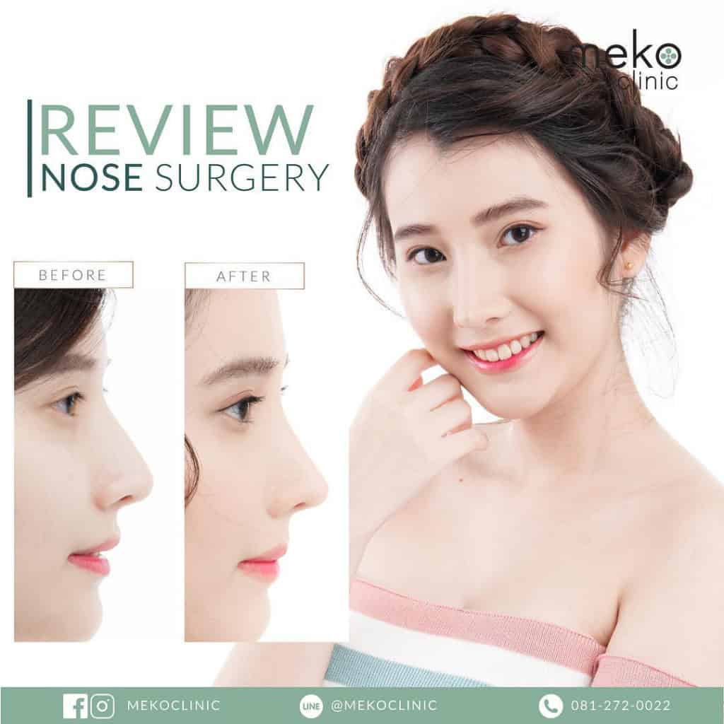เสริมจมูก ( Nose surgery ) ที่ เมโกะ คลินิก