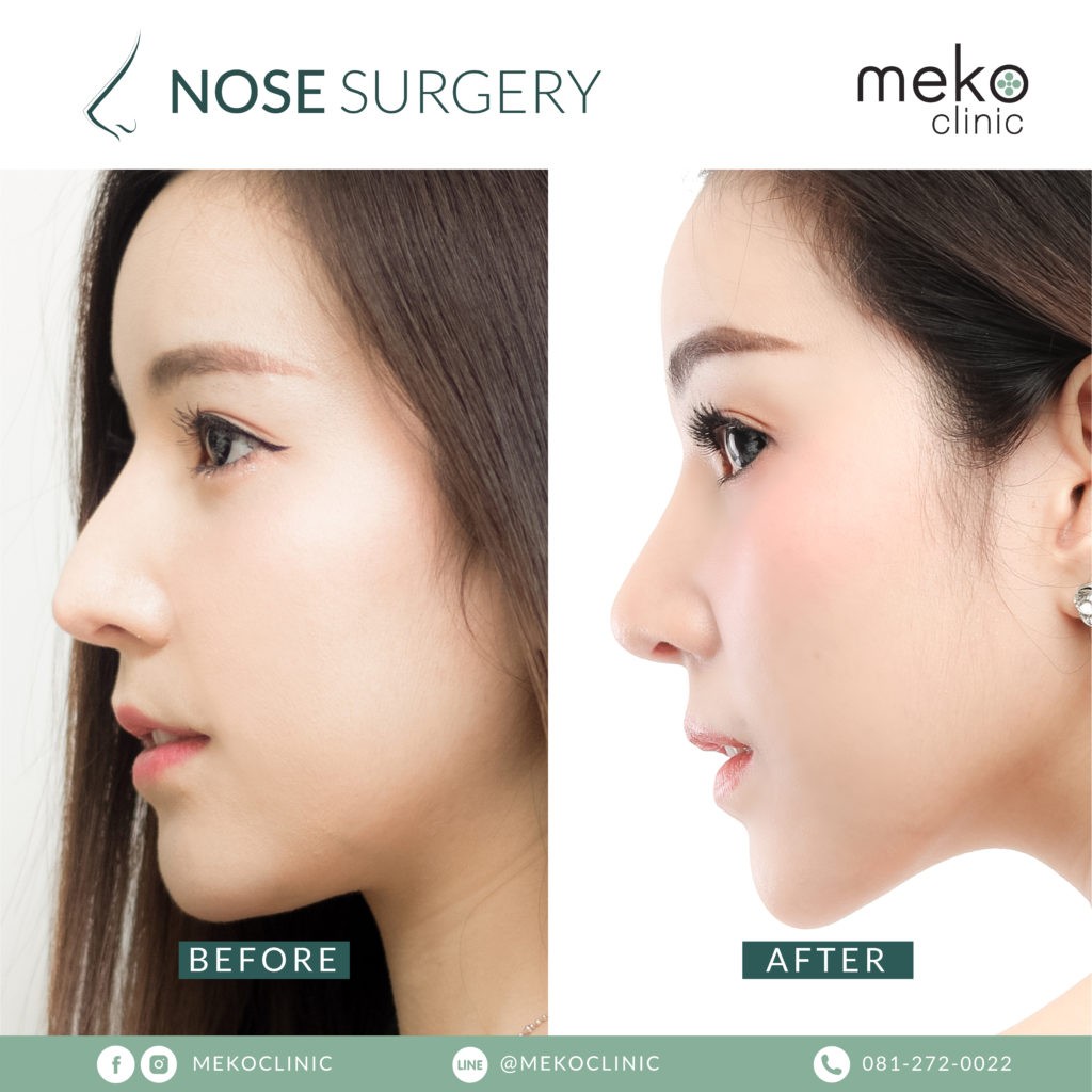 เสริมจมูก ( Nose surgery ) ที่ เมโกะ คลินิก