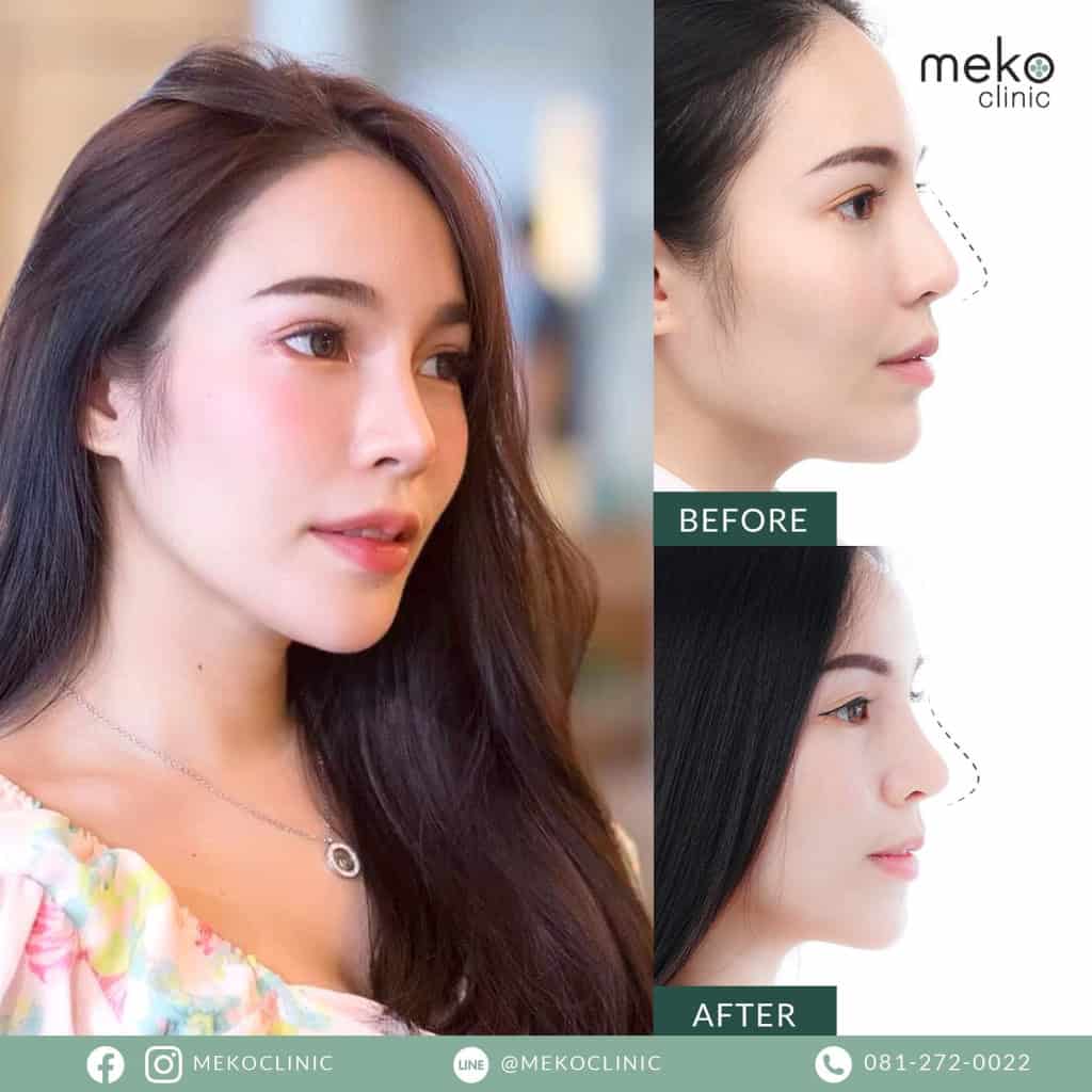 เสริมจมูก ( Nose surgery ) ที่ เมโกะ คลินิก