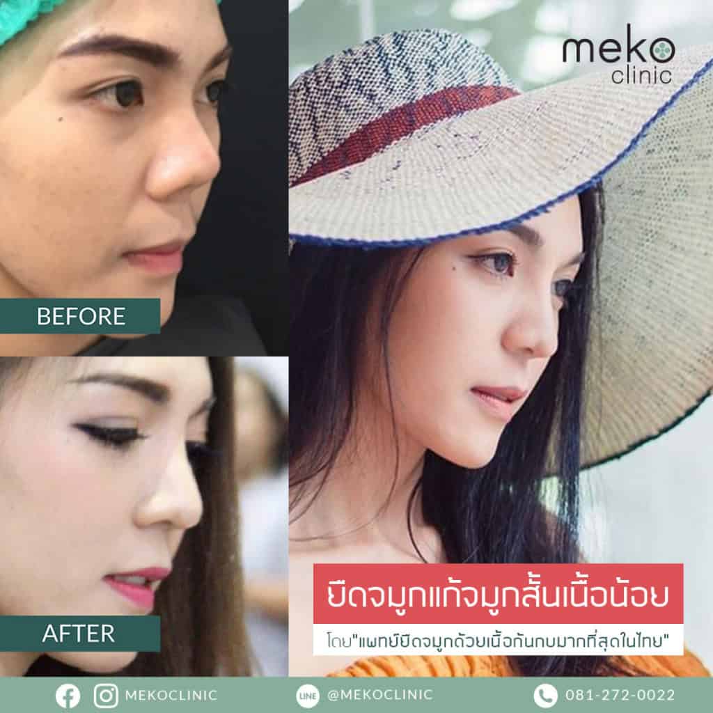 เสริมจมูก ( Nose surgery ) ที่ เมโกะ คลินิก