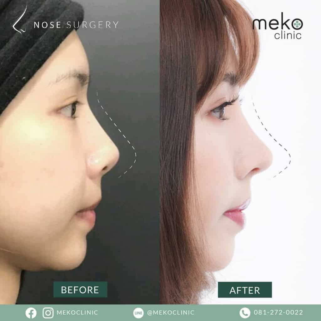 เสริมจมูก ( Nose surgery ) ที่ เมโกะ คลินิก