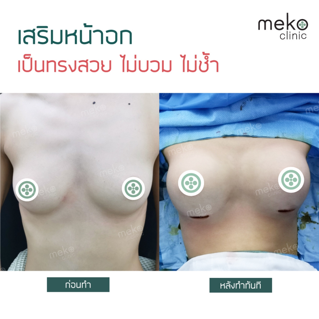 เสริมหน้าอก (breastsurgery) mekoclinic