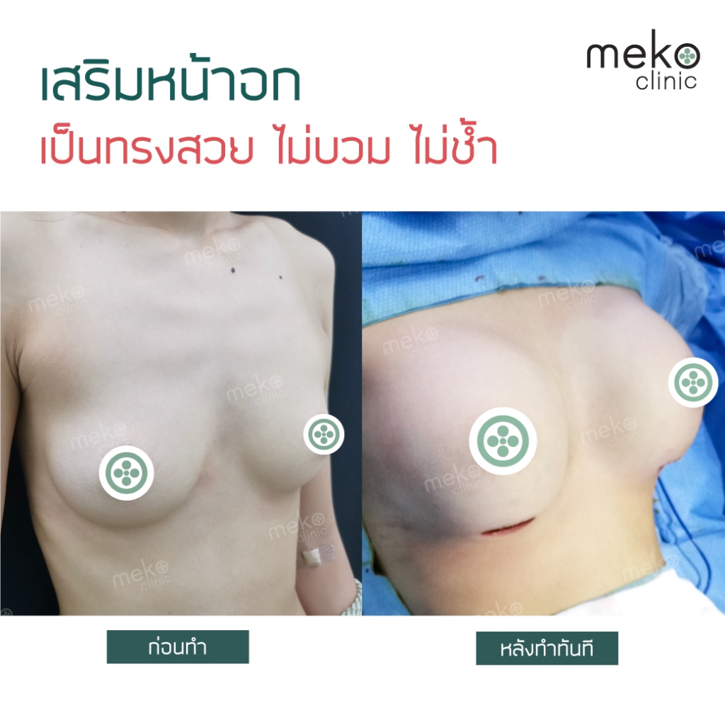 เสริมหน้าอก (breastsurgery) mekoclinic
