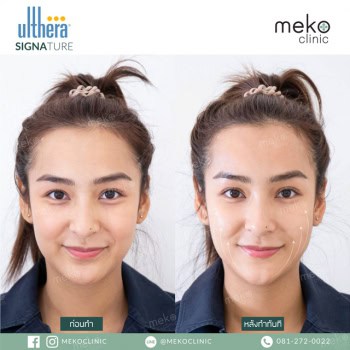 Ulthera Signature dr.ake mekoclinic