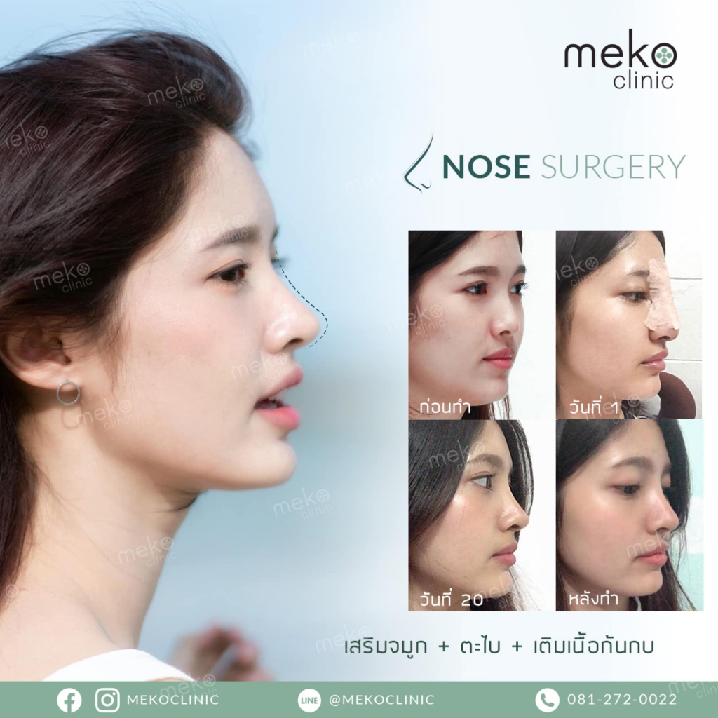 รีวิวเสริมจมูก ( Nose surgery ) ที่ เมโกะ คลินิก-3