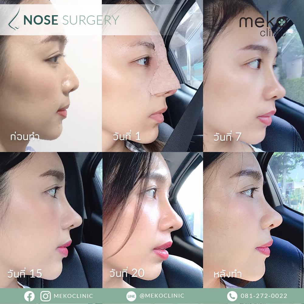 รีวิวเสริมจมูก ( Nose surgery ) ที่ เมโกะ คลินิก-5