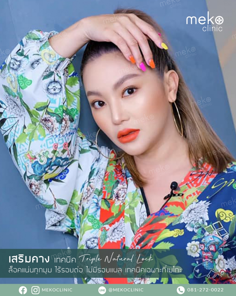 เสริมคาง เทคนิค triple natural lock โดยคุณฮารุ