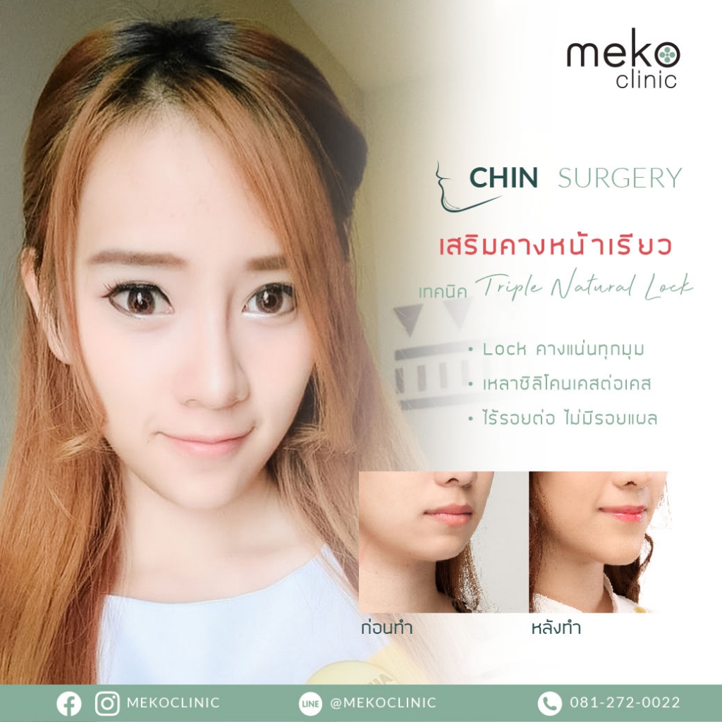 รีวิวเสริมคางปรับหน้าเรียว เทคนิค Triple natural lock-8