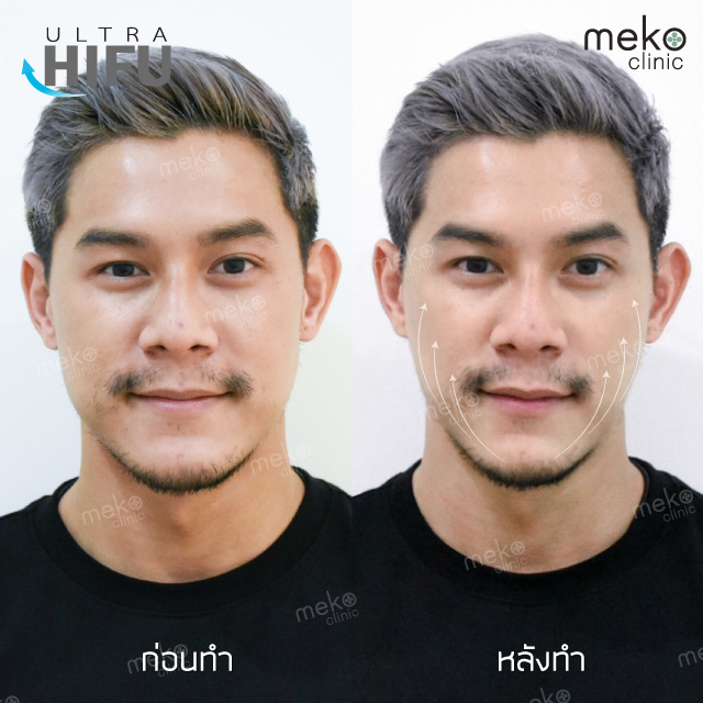 รีวิวทำ Hifu กับคุณกาย รัชชานนท์ ช่วยหน้าเรียวแบบไม่ย้อย