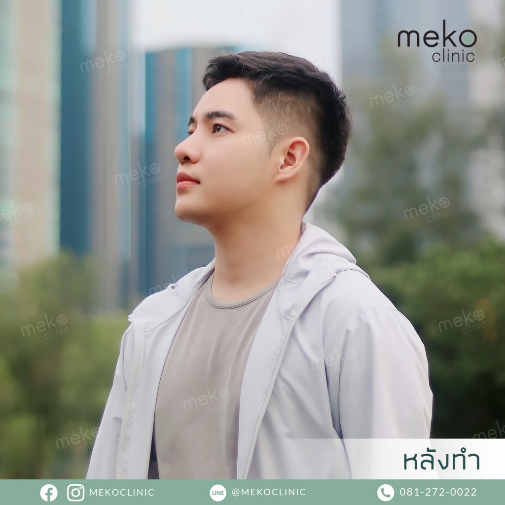 เสริมคางผู้ชาย หน้าคม หล่อเป๊ะ โดยแพทย์กานต์ [คุณเพชร]