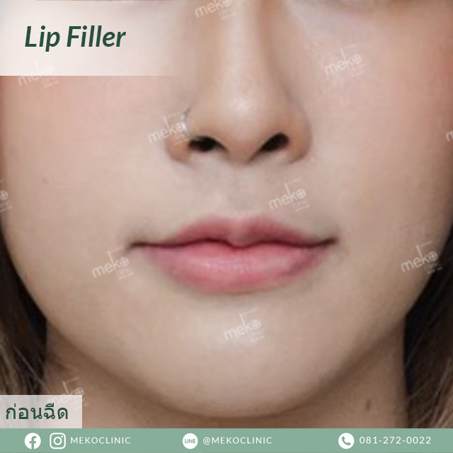 lip filler ฟิลเลอร์ปาก หมอมิ้ว เมโกะคลินิก mekoclinic