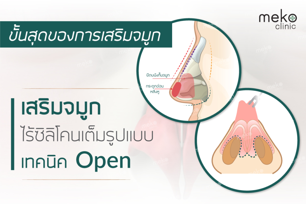 ทำความรู้จักกับการเสริมจมูกแบบ Open พร้อมข้อดีและเสีย- Meko Clinic