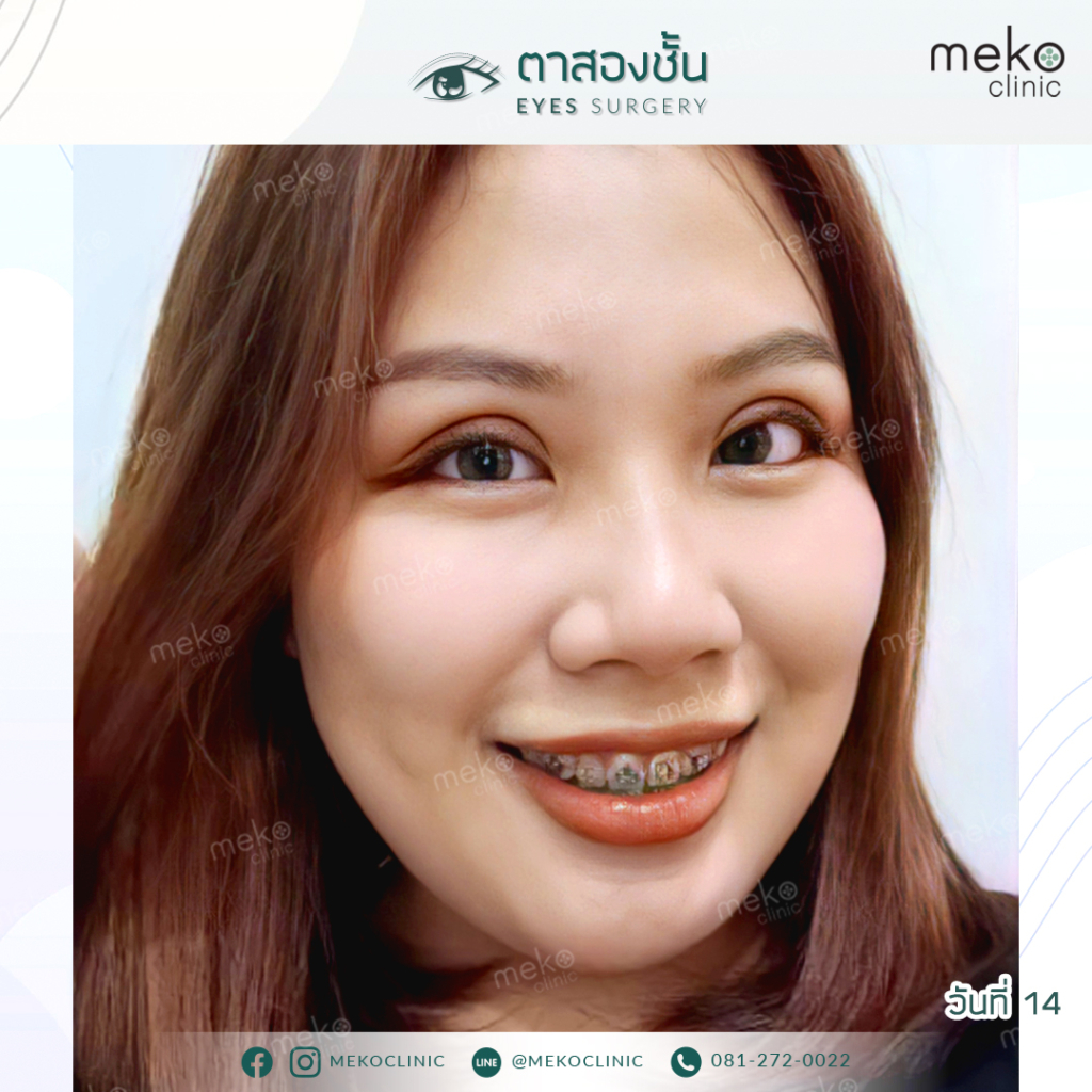 ทำตา-ฟอเฟิร์น-หลังทำ 14 วัน