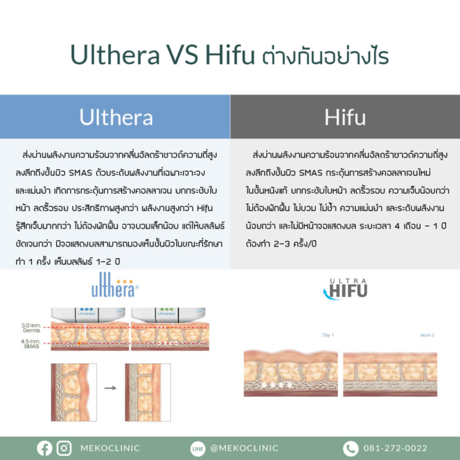 Ulthera VS hifu ต่างกันอย่างไร