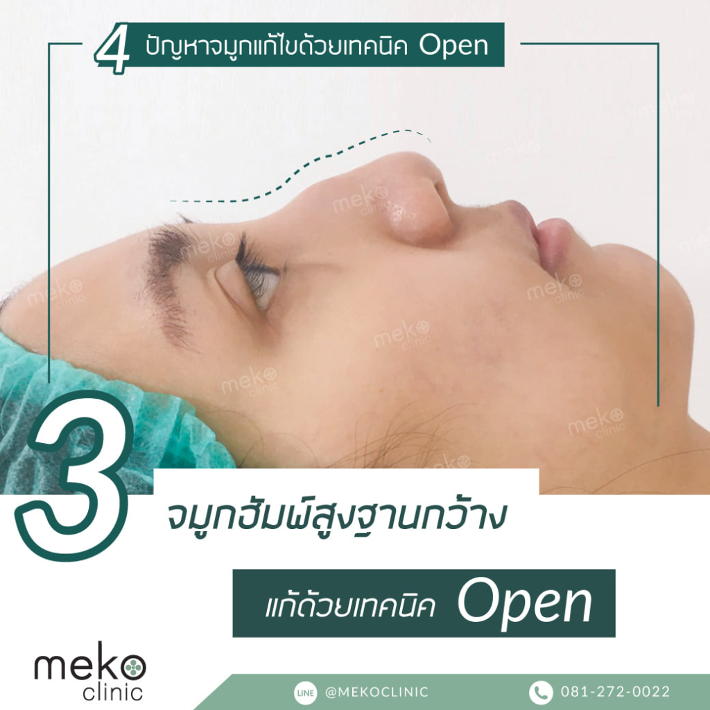 จมูกฮัมพ์สูงฐานกว้าง แก้ด้วยเทคนิค open-1