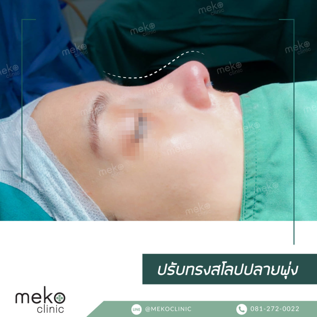 จมูกฮัมพ์สูงฐานกว้าง แก้ด้วยเทคนิค open-2
