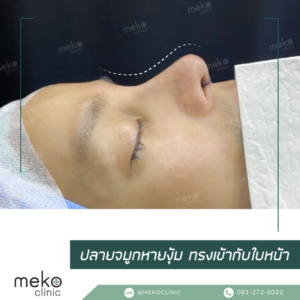 ปลายจมูกงุ้ม-แก้ด้วยเทคนิค-open-2
