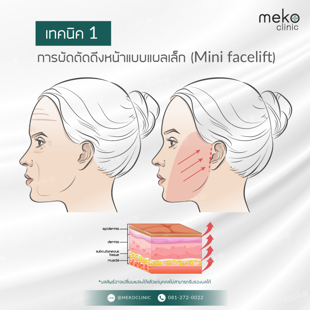 เทคนิค 1 การผัดตัดดึงหน้าแบบแผลเล็ก (Mini facelift)