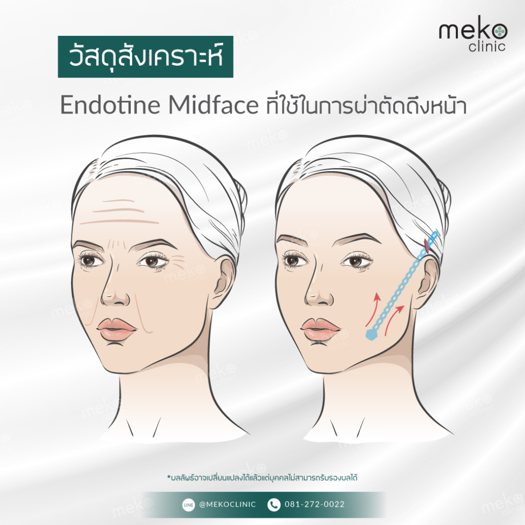 วัสดุสังเคราะห์ Endotine Midface ที่ใช้ในการผ่าตัดดึงหน้า