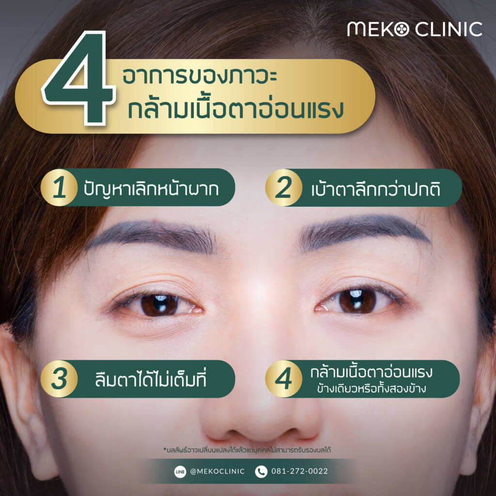 4 อาการของภาวะกล้ามเนื้อตาอ่อนแรง