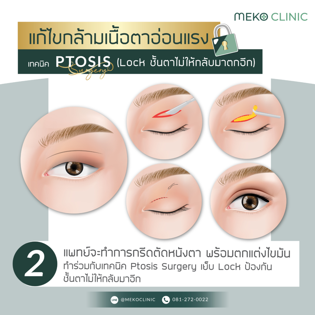 แก้ไขกล้ามเนื้อตาอ่อนแรงด้วยเทคนิค PTOSIS-2