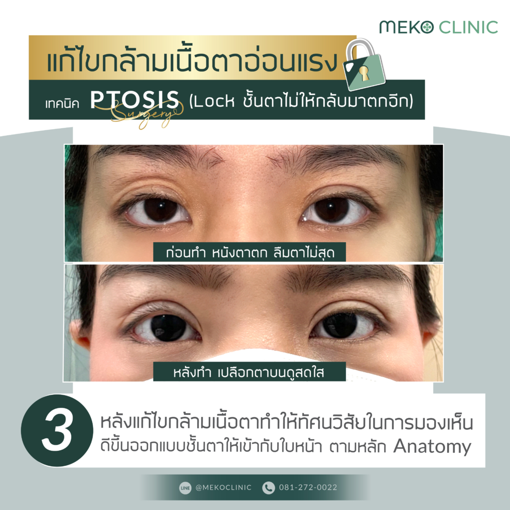 แก้ไขกล้ามเนื้อตาอ่อนแรงด้วยเทคนิค PTOSIS-3