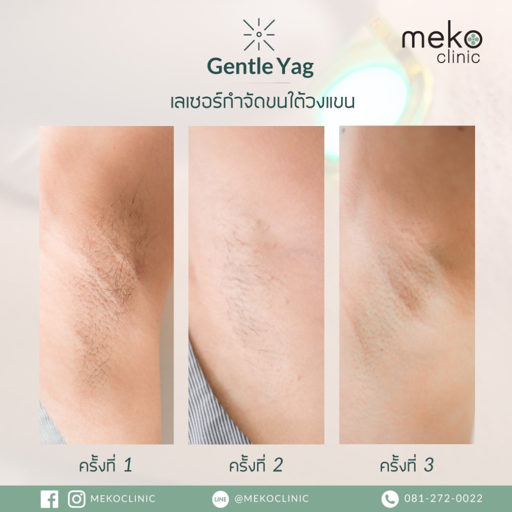 เปลี่ยนเห็นได้ชัดเมื่อกำจัดขนใต้วงแขน ด้วย Gentle Yag ที่เมโกะ คลินิก -  Meko Clinic