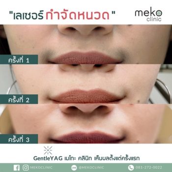 meko clinic gentle yag