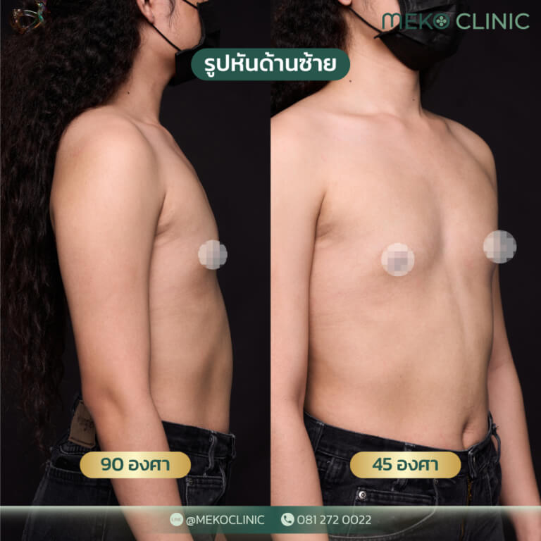 Banner-Consult-Online-Breast-Surgery-ใน-2