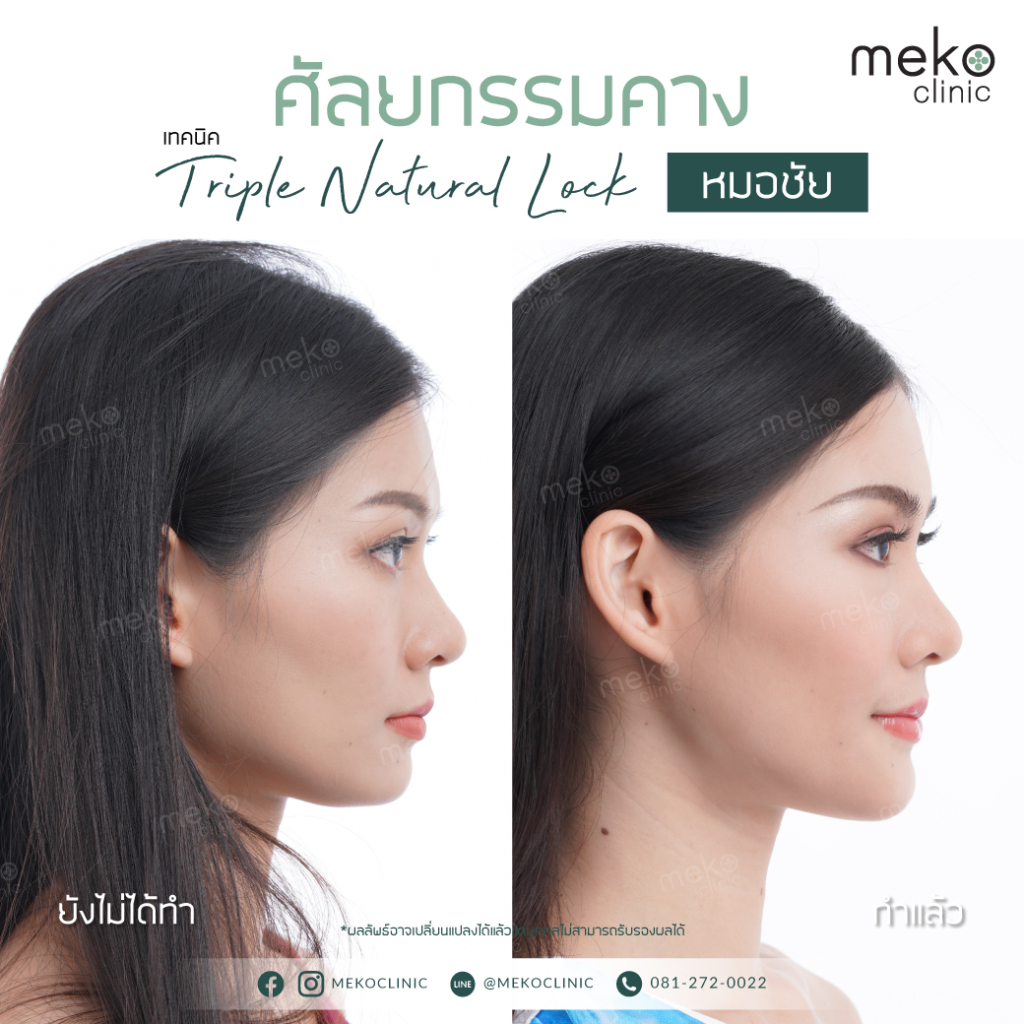 เสริมคางปรับหน้าเรียว หมอชัย เทคนิค Triple natural lock-2