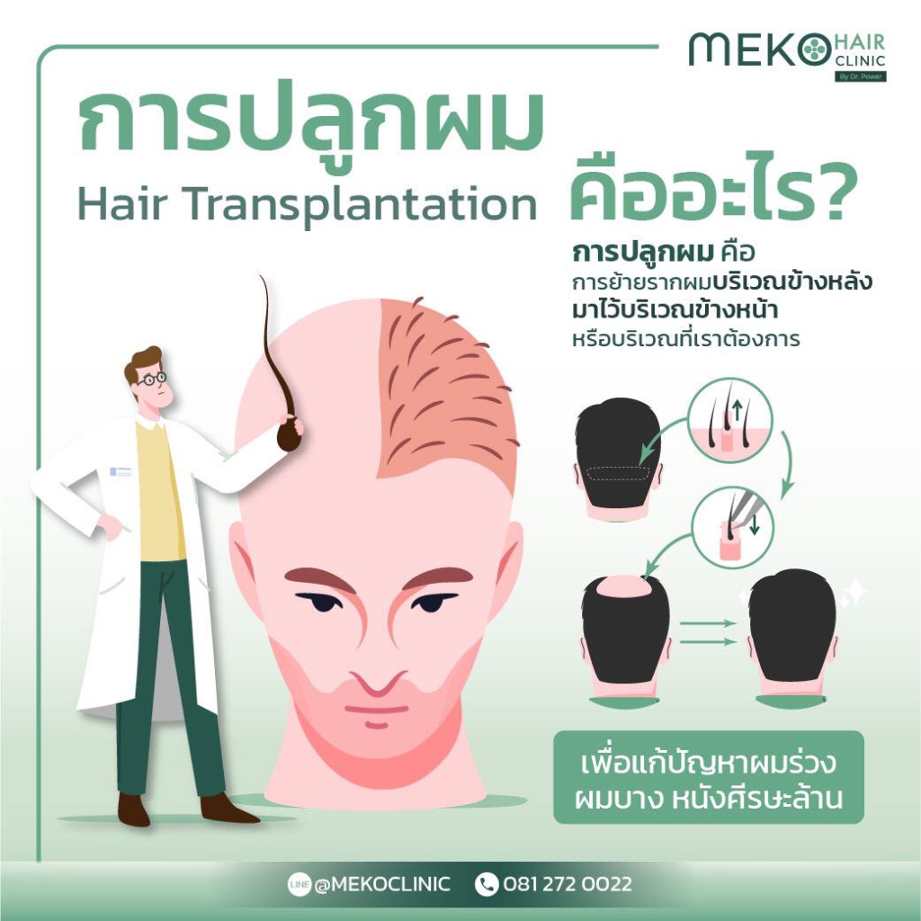 การปลูกผม (Hair tranplantation) คืออะไร 