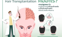 การปลูกผม(Hair Transplantation)-1