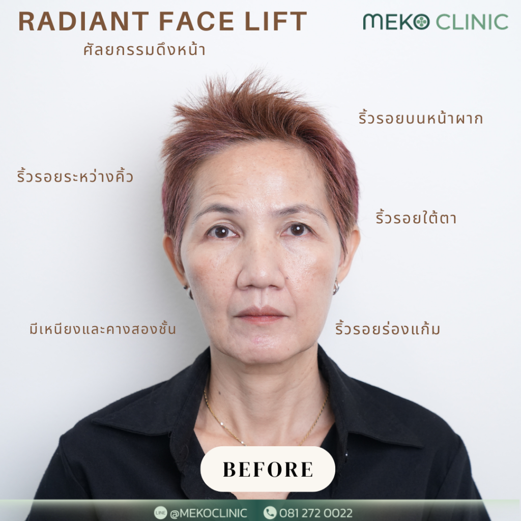 รีวิว ศัลยกรรมดึงหน้า Radiant Facelift โดยแพทย์ยศ [คุณต๊อกแต๊ก]-1