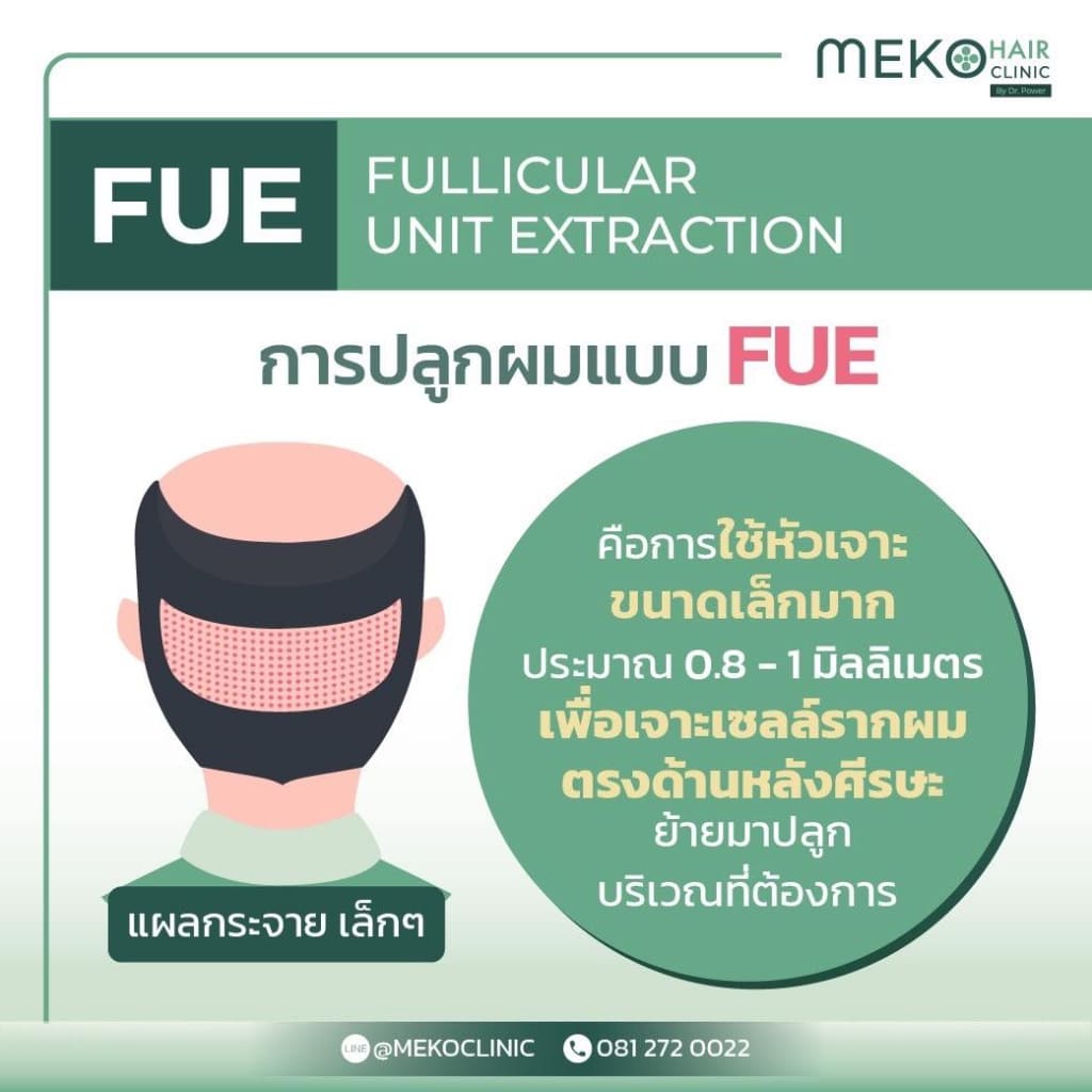 การปลูกผมแบบ FUE (Fullicular Unit Extraction)