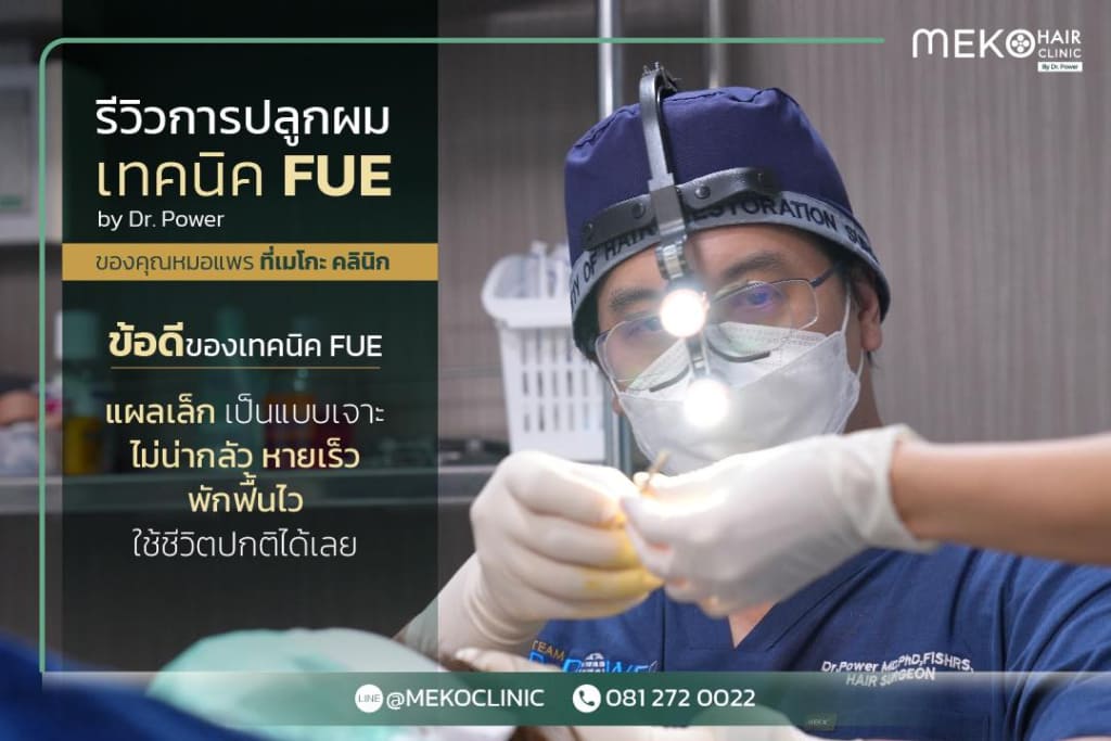 รีวิวการปลูกผมแบบ FUE (Fullicular Unit Extraction)