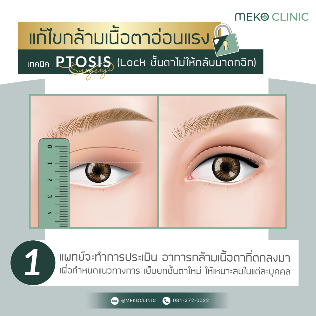 แก้ไขกล้ามเนื้อตาอ่อนแรงด้วยเทคนิค ptosis-1