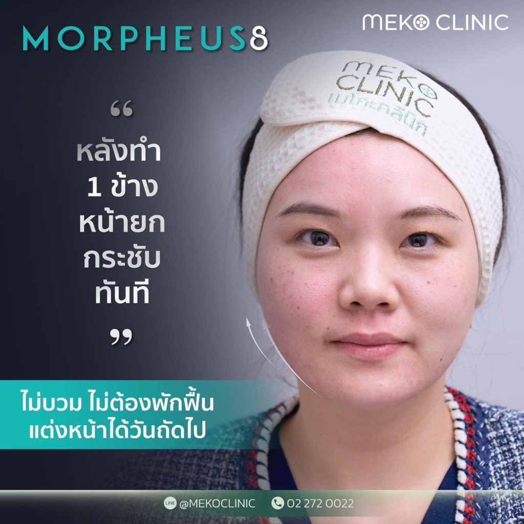 Morpheus8 กู้ผิวยับ ยกผิวหย่อน นวัตกรรมใหม่ยกกระชับผิวโดยไม่ต้องผ่าตัด-7