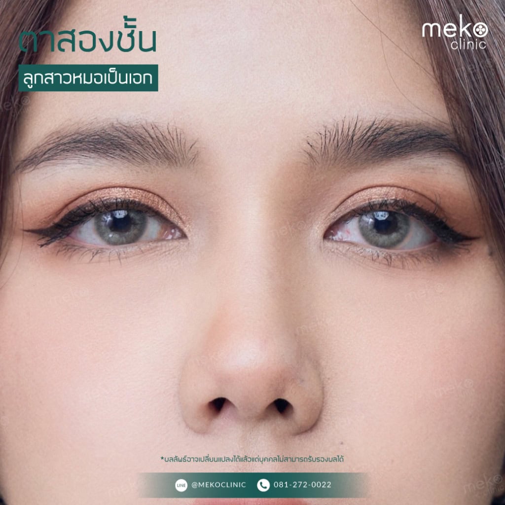 วิธีการทำศัลยกรรมตาสองชั้น และการเตรียมพร้อมก่อนเข้ารับการผ่าตัด